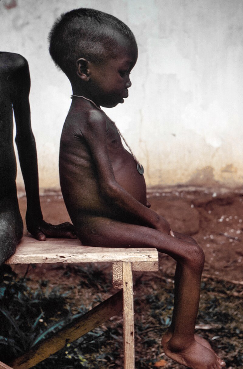 Starved girl found in a relief camp during the Nigerian-Biafran war